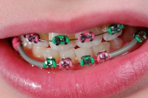 Child with Colored Braces